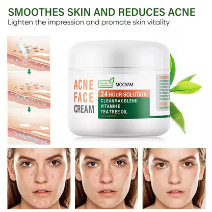 Acne face cream Lëkurë e pastër pa akne – që në ditët e para