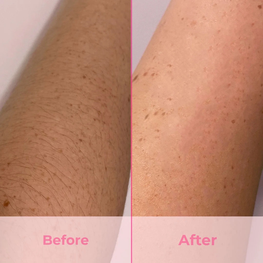 Laser IPL pajisje për heqjen e qimeve-Laser IPL pajisje për heqjen e qimeve